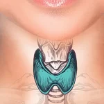 hipertireoidismo, tratamento médico em BH
